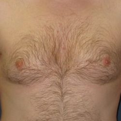 Gynecomastia Before & After Patient #21049