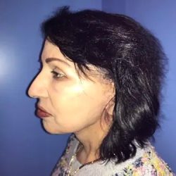Facelift Before & After Patient #21162